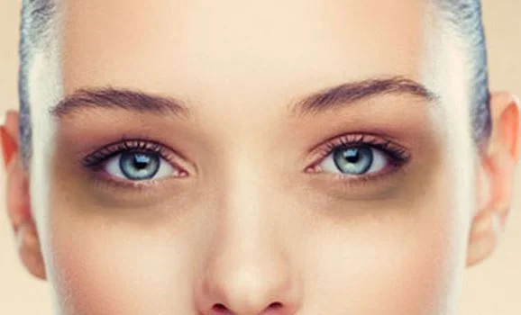 How to get rid of dark circles under eyes fast overnight get rid of dark circles
