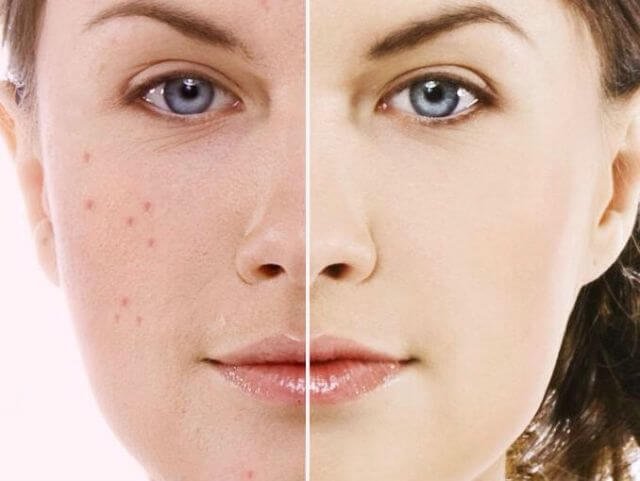 how to remove pimples how to remove pimples